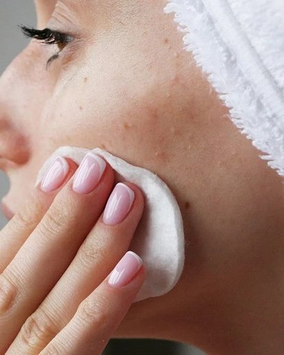 oplossingen-hormonale-acne