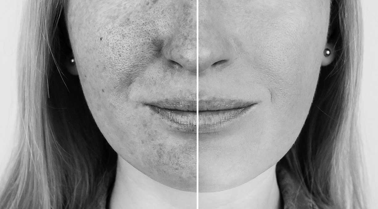 welke-zonnebrand-kiezen-2