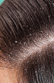 HUB_CONTENT_DHSC_CONTENT_23_FROM_A_HEALTHY_SCALP_TO_A_DANDRUFF_CONDITION.jpg